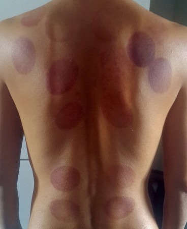 My Back After Cupping